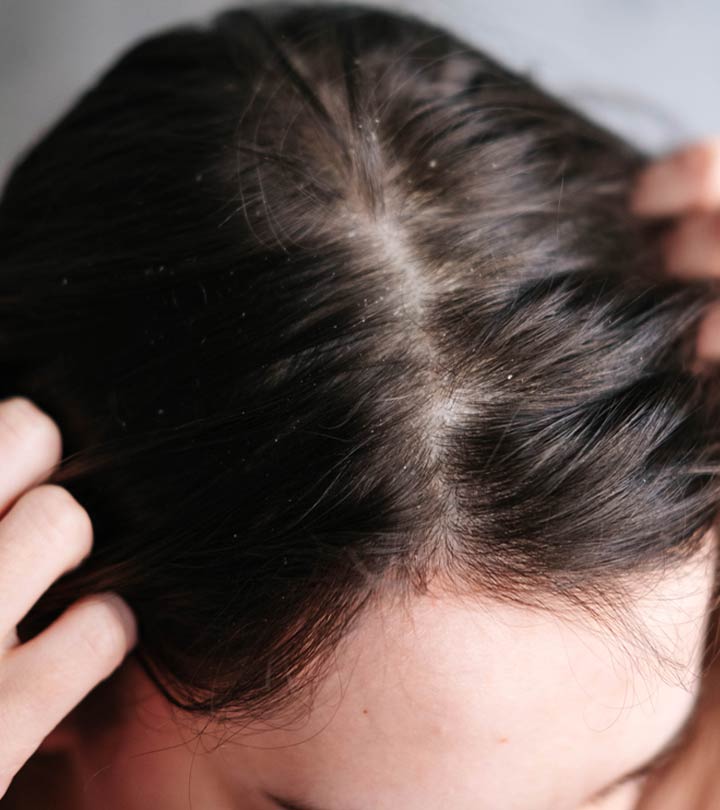 10 Best Home Remedies For Dry Scalp And Prevention Tips