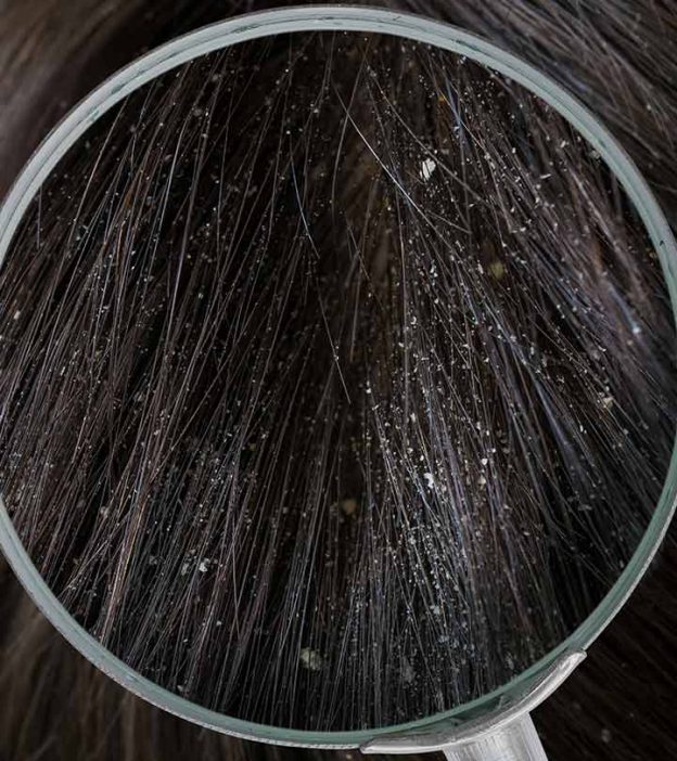 Different Types Of Dandruff And How To Stop Them