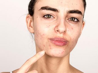 Hormonal Acne: Causes, How To Treat It, And Foods To Avoid