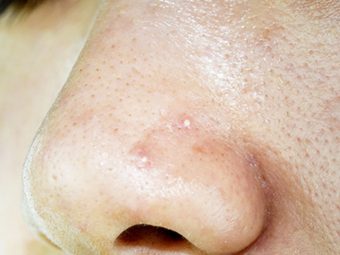 How To Get Rid Of Whiteheads On Nose: Causes And Treatment