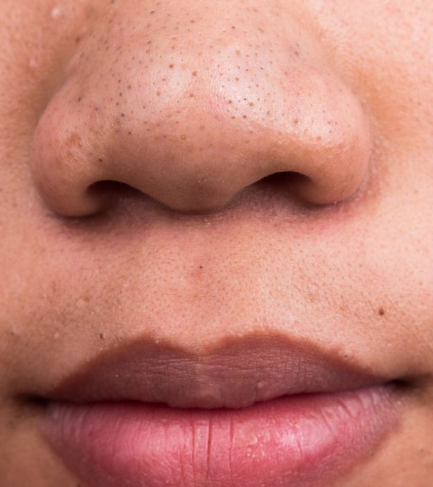 How To Remove Deep Blackheads Safely And Effectively