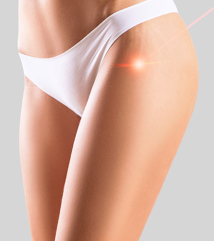 Laser Stretch Mark Removal: Types, Cost, And How It Works