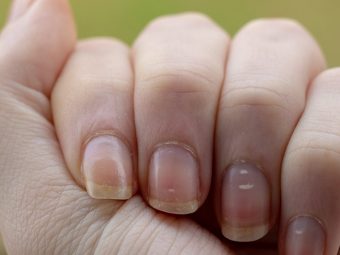 What Are White Spots On Nails And How To Get Rid Of Them?