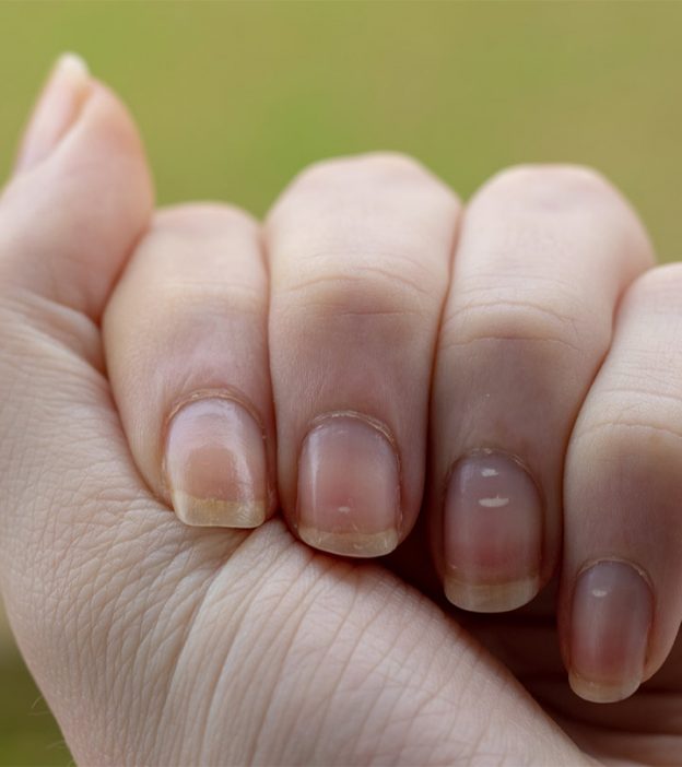 What Are White Spots On Nails And How To Get Rid Of Them?